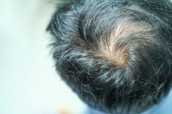 Calvitie : la greffe de cheveux comme solution